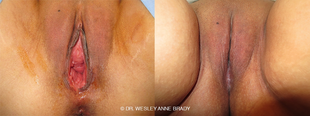 womenswellnessinstitute vaginoplasty038
