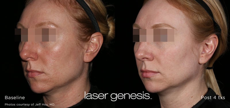 Laser Genesis 6 sm (1)