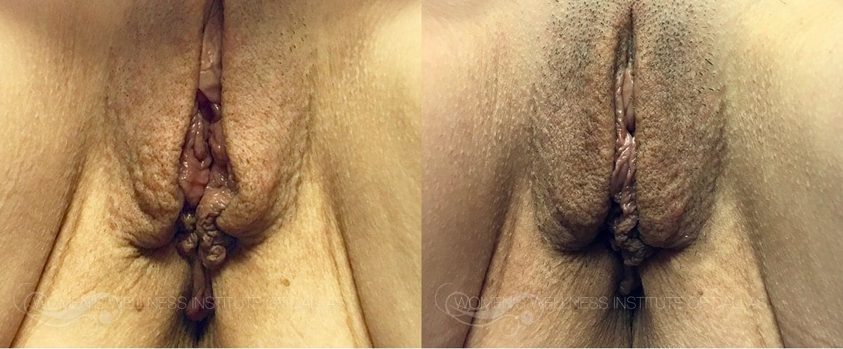 ThermiVa Before and After Photo Patient 7 2