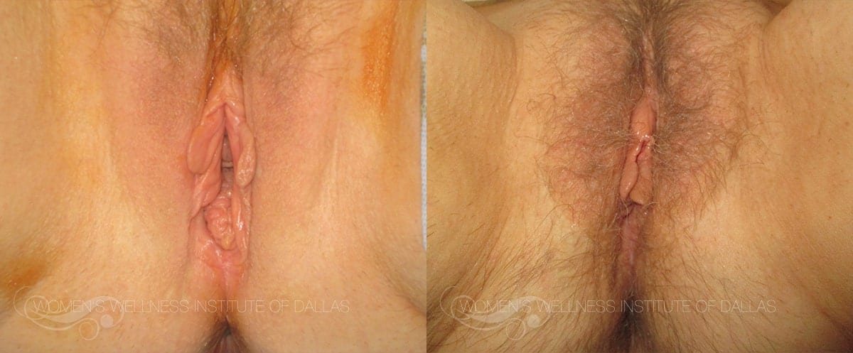 Vaginal Rejuvenation Before and After Slider Photo A