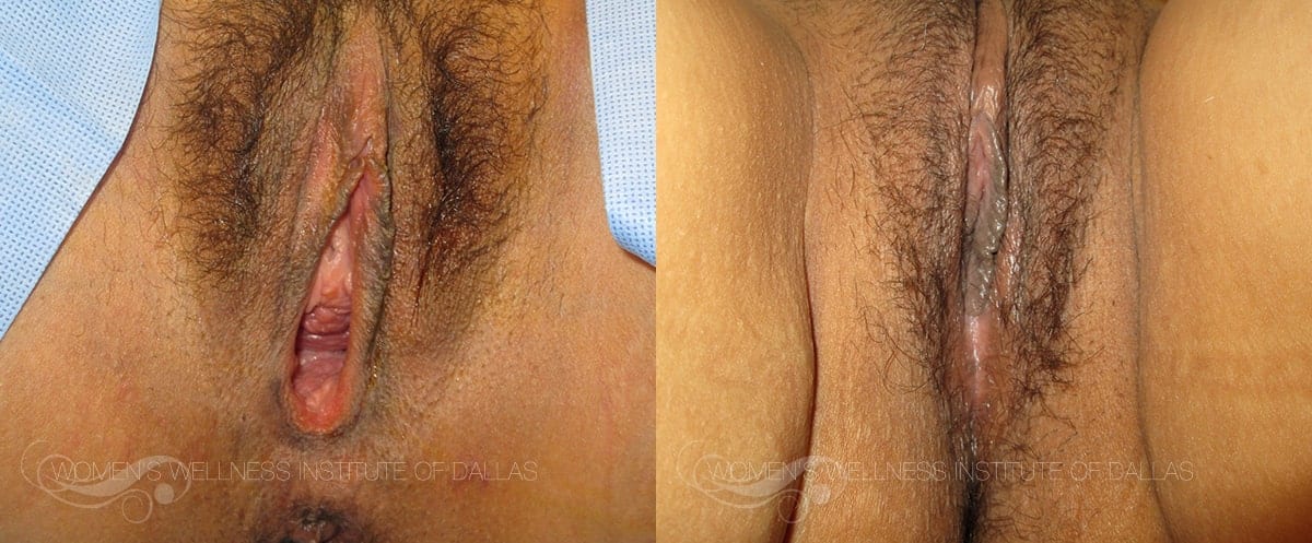 Vaginal Rejuvenation Before and After Slider Photo B