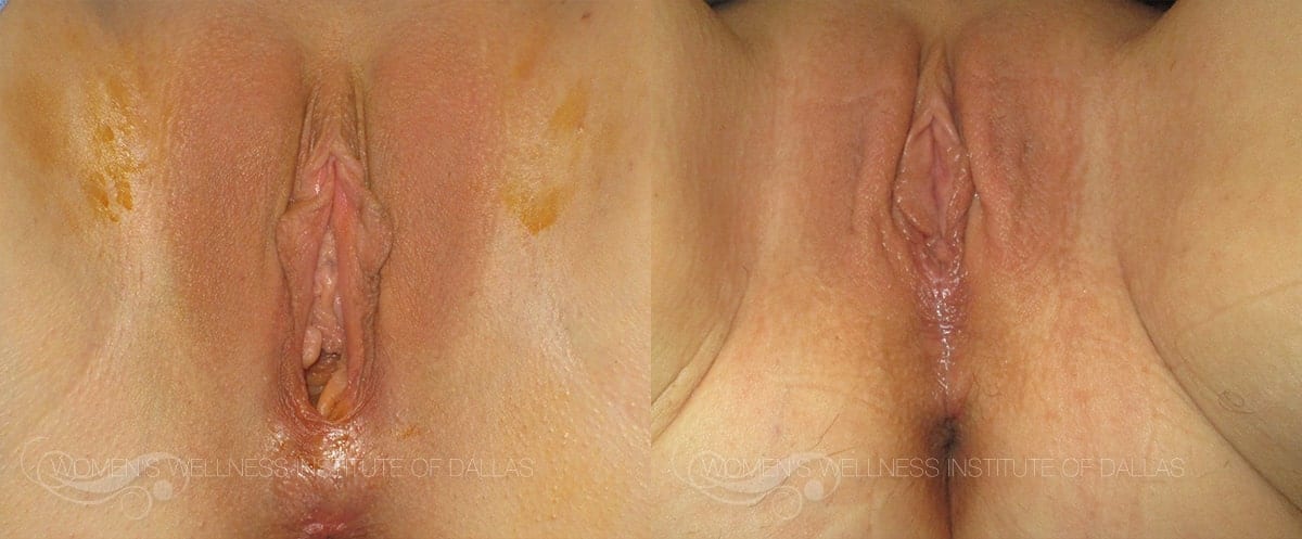Vaginal Rejuvenation Before and After Slider Photo D