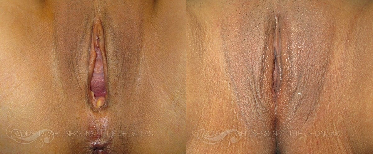Vaginal Rejuvenation Before and After Slider Photo F