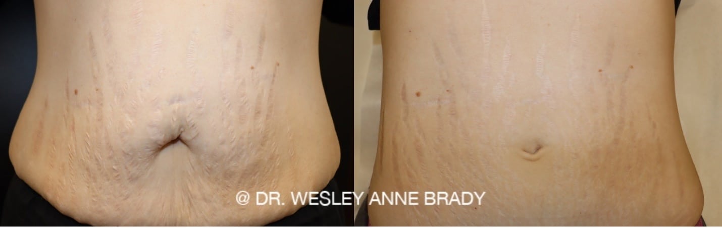 Minimise stretch marks with microneedling - Lasermed: Laser Clinic & facial  rejuvenation