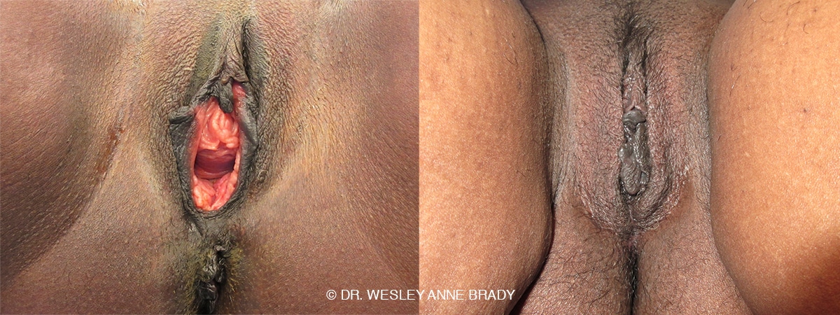womenswellnessinstitute vaginoplasty041