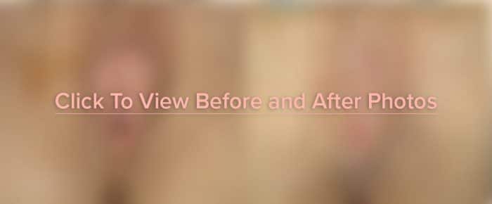 Click Here to View Before and After Photos of Vaginoplasty